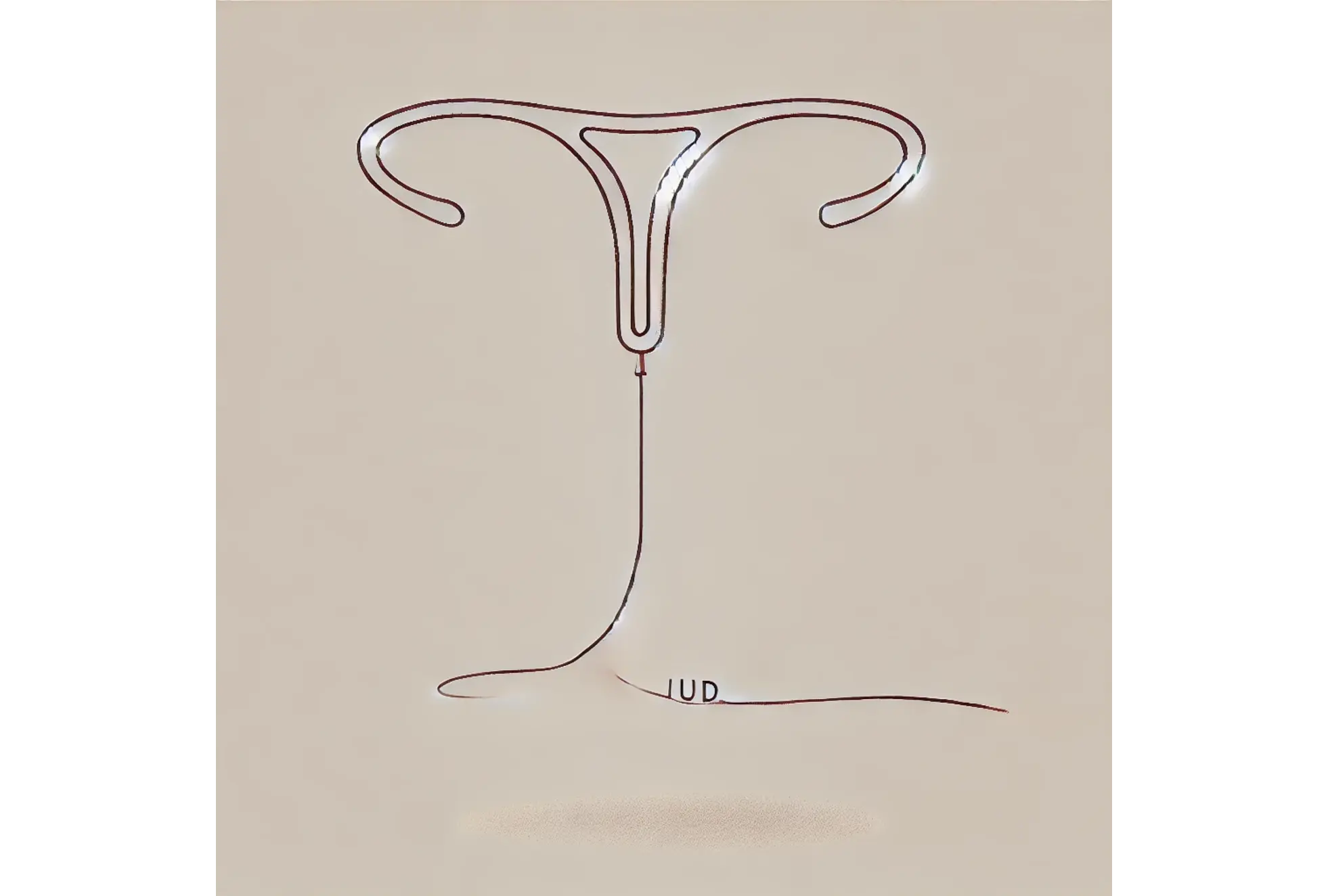 Illustration comparing Hormonal IUD and Non-Hormonal IUD, highlighting their benefits, side effects, and costs